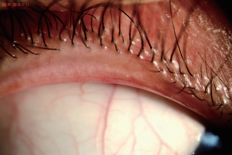 Phalcon Digital Slit Lamp Eyelid Margin Analysis