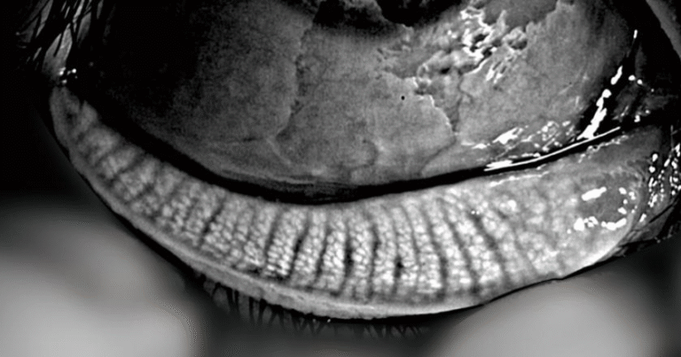 Phalcon Digital Slit Lamp Auto Meibography w/gland loss detection