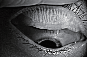 ODoF - Dry Eye & Aesthetics Auto Meibography w/gland loss detection