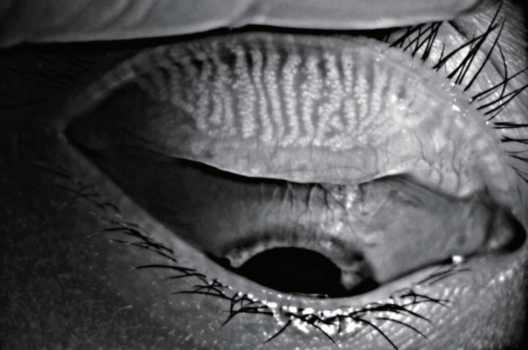 Phalcon Digital Slit Lamp Auto Meibography w/gland loss detection