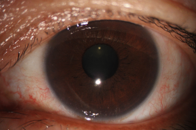 Phalcon Digital Slit Lamp Redness Analysis