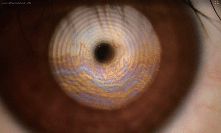 Phalcon Digital Slit Lamp Auto Interferometry (lipid layer)