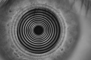 ODoF - Dry Eye & Aesthetics Auto NIBUT & Tear Meniscus Height (TMH)