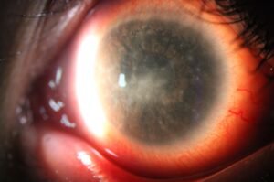 ODoF - Dry Eye & Aesthetics Cataract