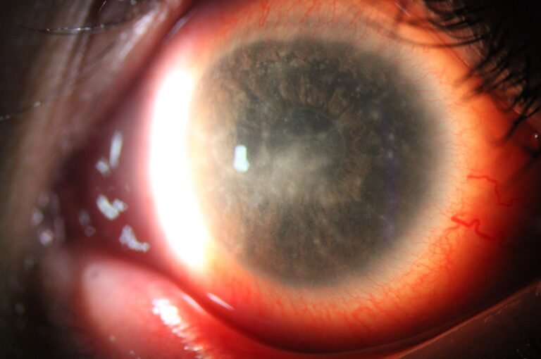 Phalcon Digital Slit Lamp Cataract