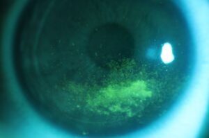 ODoF - Dry Eye & Aesthetics Fluorescein