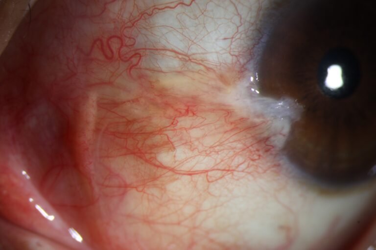 Phalcon Digital Slit Lamp Pterygium